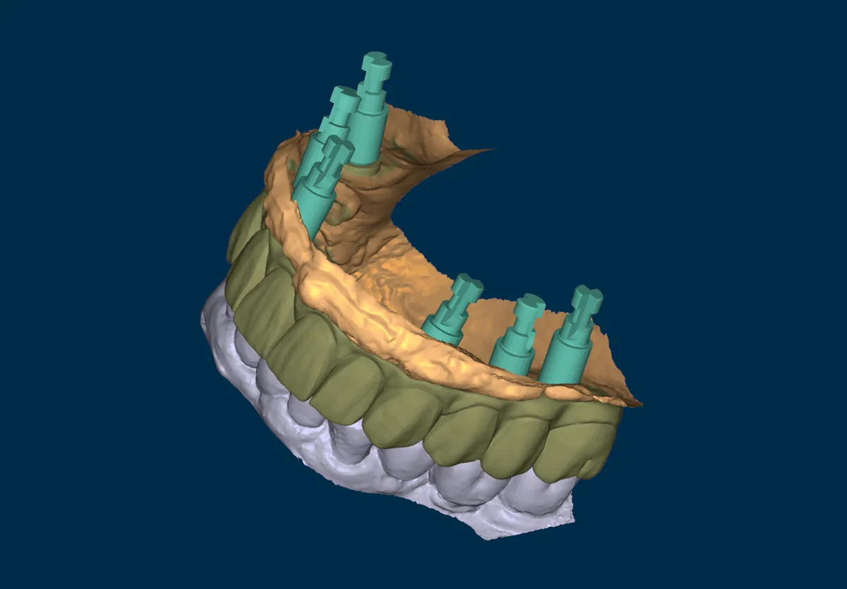 Planejamento digital de guia cirúrgica com implantes visualizados em 3D